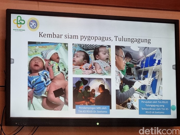kembar siam pygopagu atau dempet pantat tulungagung dipisahkan di rsu dr soetomo