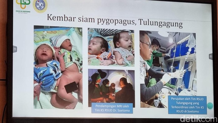 kembar siam pygopagu atau dempet pantat tulungagung dipisahkan di rsu dr soetomo