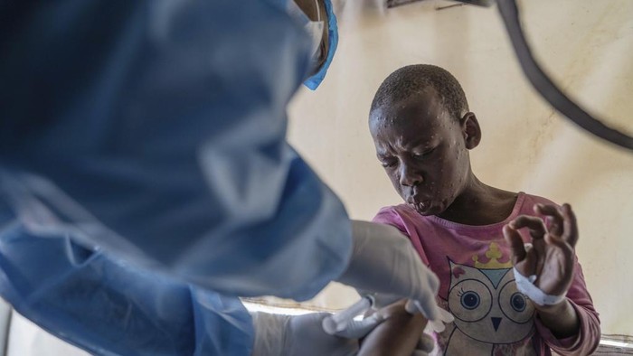 Organisasi Kesehatan Dunia menyatakan wabah mpox di Afrika sebagai keadaan darurat global. Kongo akan menerima vaksin pertama untuk atasi wabah tersebut.