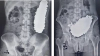 Salah satu contoh kasus dialami oleh seorang pria di Iran dan dipublikasikan di Journal of Medical Case Reports. Pasien berusia 36 tahun, datang ke RS dengan nyeri perut kronis, sering muntah, serta intoleransi terhadap cairan dan makanan. Dokter menemukan 452 benda logam di perutnya, seperti kunci hingga mur. (Foto: Journal of Medical Case Report).