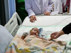 Dokter RSU Soetomo Pisahkan Kembar Siam Dempet Bokong, Satu Bayi Meninggal