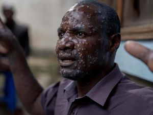 Cerita Dokter Tangani Kengerian Kasus Mpox di Afrika