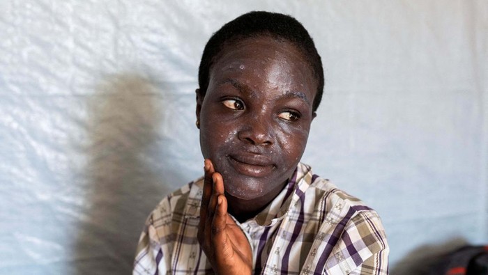 Furaha Elisabeth applies medication on the skin of her child Sagesse Hakizimana who is under treatment against Mpox, an infectious disease caused by the Mpox virus that causes a painful rash, enlarged lymph nodes and fever, at a health centre in Munigi, Nyiragongo territory, near Goma in North Kivu province of the Democratic Republic of Congo August 19, 2024. REUTERS/Arlette Bashizi