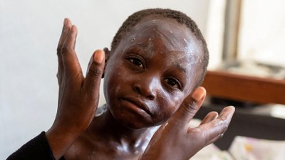 Potret Warga Kongo yang Terinfeksi Wabah Mpox