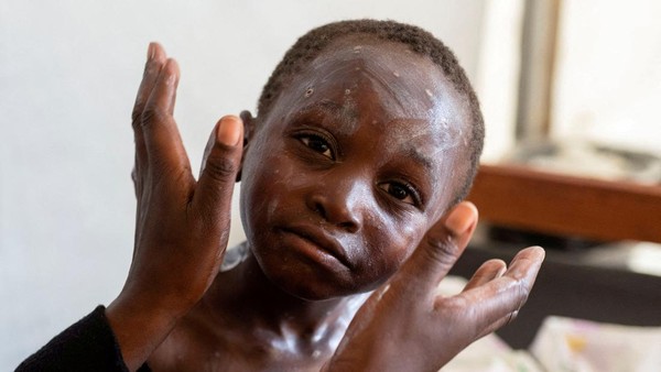 Potret Warga Kongo yang Terinfeksi Wabah Mpox