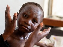 Potret Warga Kongo yang Terinfeksi Wabah Mpox