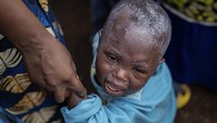 Mpox atau monkeypox (cacar monyet) adalah penyakit menular yang disebabkan oleh virus monkeypox. Virus ini berasal dari keluarga yang sama dengan virus penyebab cacar. Orang yang terkena Mpox sering mengalami ruam yang bisa menyakitkan, disertai dengan gejala lain seperti demam dan pembengkakan kelenjar getah bening. (AP Photo/Moses Sawasawa)