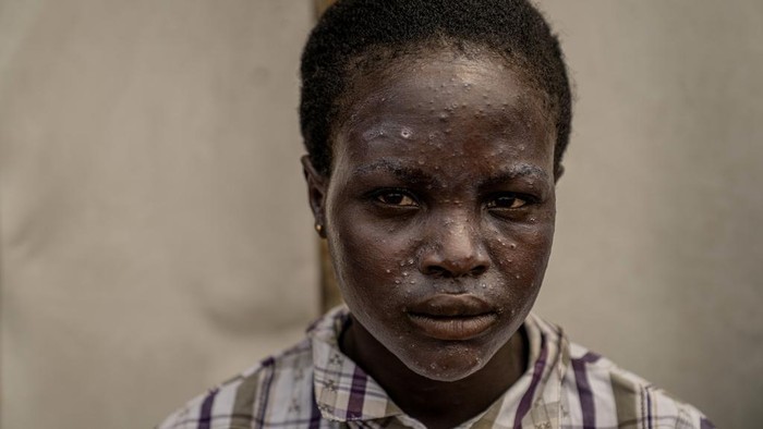 Fakta-fakta Mpox di Afrika Nyaris Tembus 30 Ribu Kasus, Inikah yang Jadi Pemicunya?