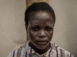 Kesaksian Dokter di Afrika Tangani Pasien Mpox, Separah Ini Kondisinya