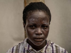 Fakta-fakta Mpox di Afrika Nyaris Tembus 30 Ribu Kasus, Inikah yang Jadi Pemicunya?
