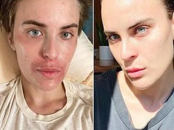 Alami Gangguan Kelupas Kulit Sendiri, Begini Kondisi Wajah Anak Demi Moore