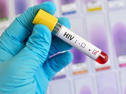 Orang Ketujuh yang Sembuh dari HIV, Jalani Donor Stem Cell
