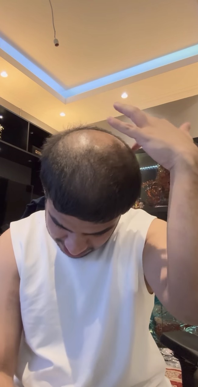 Fadil pun menceritakan mengapa rambutnya itu bisa mengalami kerontokan dan kebotakan. Rupanya karena pada tahun 2017 ia pernah bleaching sendiri rambutnya hingga sebanyak 7 kali. Setelah proses bleaching tersebut kulit kepalanya langsung terasa panas dan memerah. Rambutnya pun perlahan mulai rontok. Foto: Instagram/@fadiljaidi