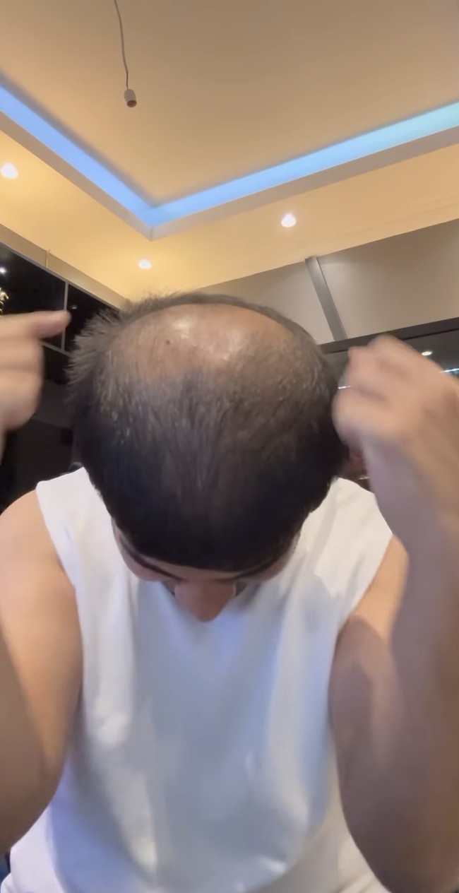 Kerontokan terparah rambutnya ialah pada tahun ini. Bahkan kerontokan tersebut sampai menyebabkan bagian tengah rambut Fadil menjadi botak dan membuatnya jadi tidak percaya diri. Foto: Instagram/@fadiljaidi