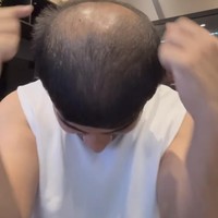 Kerontokan terparah rambutnya ialah pada tahun ini. Bahkan kerontokan tersebut sampai menyebabkan bagian tengah rambut Fadil menjadi botak dan membuatnya jadi tidak percaya diri. Foto: Instagram/@fadiljaidi