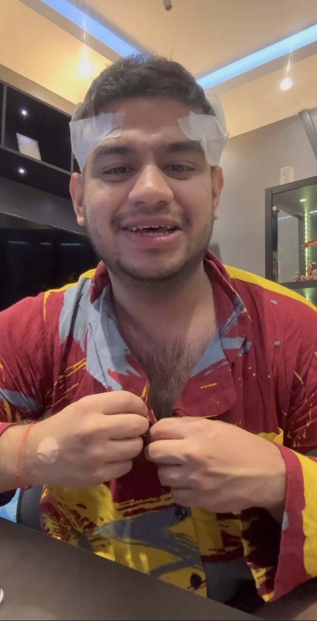 Setelah berkonsultasi dan yakin jika apa yang akan dijalaninya tidak menyalahi aturan agama, Fadil pun memutuskan untuk menjalani tanam rambut. Ia pun memamerkan penampilannya usai transplantasi rambut tersebut. Foto: Instagram/@fadiljaidi