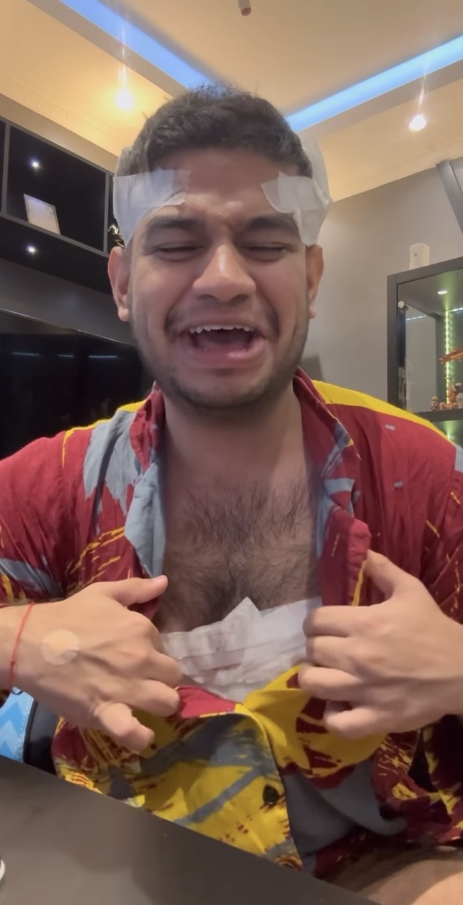 Uniknya, ternyata Fadil menggunakan bulu dadanya sendiri untuk ditanamkan ke rambutnya. Ia pun memamerkan baagian dadanya yang juga sama-sama diperban seperti bagian kepalanya. Foto: Instagram/@fadiljaidi