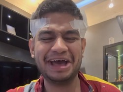 8 Foto Fadil Jaidi Jalani Tanam Rambut Pakai Bulu Dada Karena Alami Kebotakan