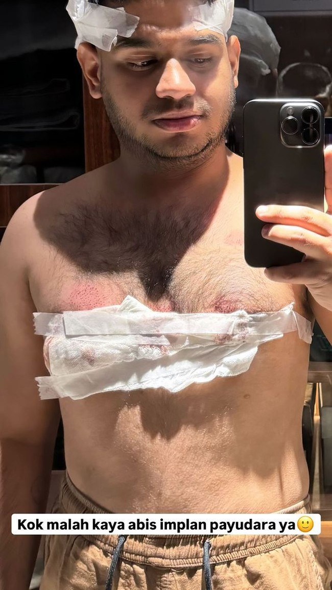 Selalu kocak dan bikin tertawa, Fadil menyebut jika dirinya malah terlihat seperti habis melakukan implan payudara alih-alih tanam rambut. Fadil juga sempat mengungkapkan jika prosedur tanam rambutnya itu ia jalani di Indonesia. Foto: Instagram/@fadiljaidi