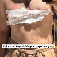 Selalu kocak dan bikin tertawa, Fadil menyebut jika dirinya malah terlihat seperti habis melakukan implan payudara alih-alih tanam rambut. Fadil juga sempat mengungkapkan jika prosedur tanam rambutnya itu ia jalani di Indonesia. Foto: Instagram/@fadiljaidi