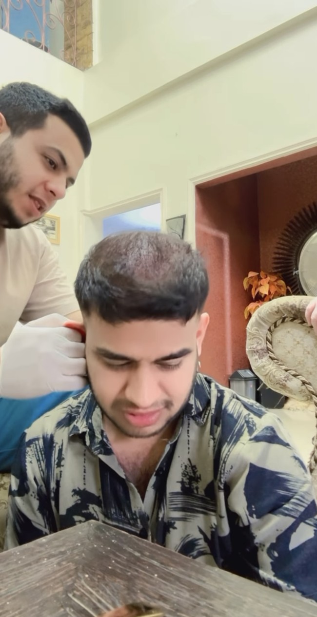 Bagian yang ikut menjalani prosedur tanam rambut itu juga tampak dibantu dibersihkan oleh kakak Fadil yang merupakan seorang dokter, Yislam Jaidi. Sambil membersihkan kepala Fadil, Yislam pun tertawa, ditambah saat dirinya mengingatkan Fadil jika adiknya itu harus datang ke acara wisuda Yislam dengan rambut rambut botak tersebut. Foto: Instagram/@fadiljaidi