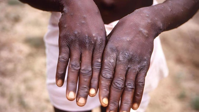 Thailand umumkan kasus mpox mematikan pertama di Asia - Apa gejala dan bagaimana penyebarannya?
