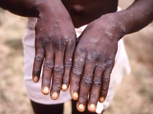 Dirjen WHO soal Wabah Mpox: Dapat Dihentikan