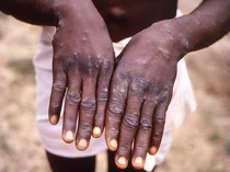 7 Negara yang Laporkan Varian Mpox Mematikan, Salah Satunya di Asia Tenggara