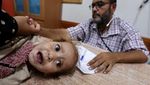 Wabah Polio Jadi Penderitaan Baru Warga Gaza