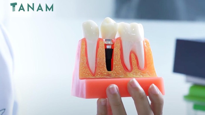 Tanam Gigi Jadi Solusi Terkini untuk Atasi Gigi Ompong