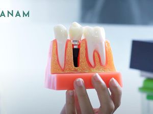 Tanam Gigi Jadi Solusi Terkini untuk Atasi Gigi Ompong