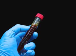 Situasi Mpox di RD Kongo Makin Ngeri, Catat Lebih dari 600 Kasus Kematian