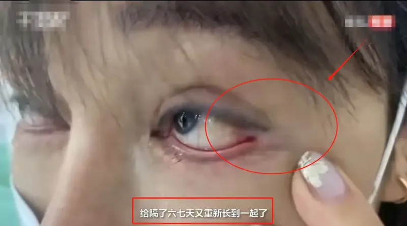 Operasi plastik mata gagal, bola mata terjahit ke kulit.