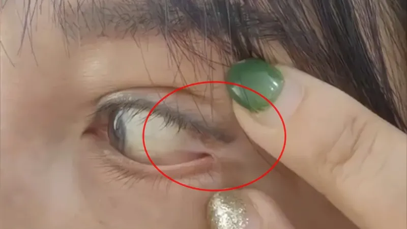 Operasi plastik mata gagal, bola mata terjahit ke kulit.