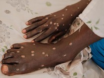 Kisah Para Penyintas Berjuang untuk Sembuh dari Mpox