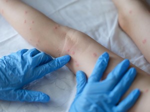 Kemenkes Segera Terbitkan Surat Edaran  Waspada Cacar Air dan Gondongan, Ada  Apa?