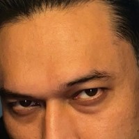 Akibat penyakit hipertiroid tersebut, tak hanya bobot tubuh Indra yang terkuras hingga 15 kg, melainkan semua lemak di tubuhnya, termasuk area wajah juga ikut habis. Area mata Indra pun jadi terlihat kurang fresh karena cekung dan gelap. Foto: Instagram/@indrabruggman