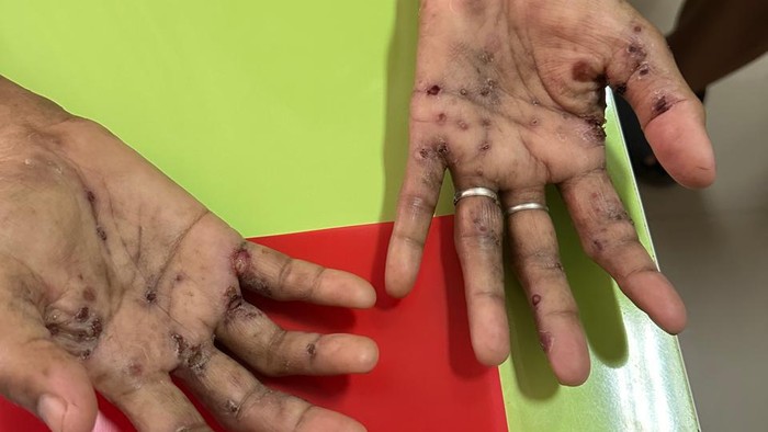 Pasien suspect monkey pox di Palembang.