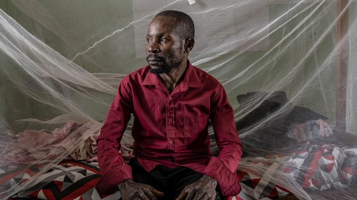 A man suffering from mpox waits for treatment at the Kamituga General Hospital in South Kivu Congo, Wednesday, Sept. 4, 2024. (AP Photo/Moses Sawasawa)