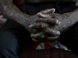 Zambia Laporkan Kasus Pertama Mpox, Variannya Masih Tidak Diketahui