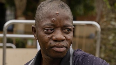 Potret Kondisi Pasien Mpox di Kongo, Sudah Ada 17 Ribu Orang Terinfeksi
