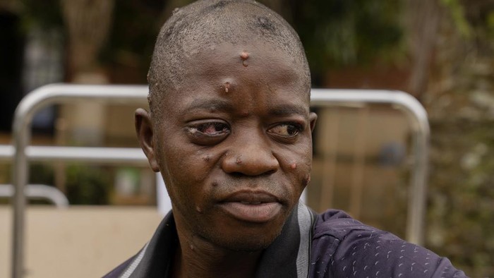 A man suffering from mpox waits for treatment at the Kamituga General Hospital in South Kivu Congo, Wednesday, Sept. 4, 2024. (AP Photo/Moses Sawasawa)