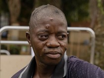 Potret Kondisi Pasien Mpox di Kongo, Sudah Ada 17 Ribu Orang Terinfeksi