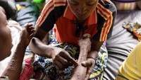 Dokter menyoroti bagaimana mpox dapat menyebabkan komplikasi serius jika tidak ditangani, termasuk lesi genital.