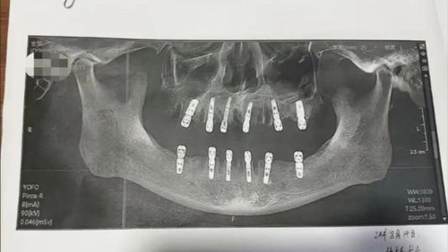 seorang pria lanjut usia meninggal dunia setelah mencabut menjalani pencabutan gigi