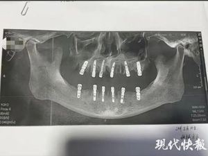 Berkaca Kasus Viral Pria China, Ini Saran Dokter Biar Cabut Gigi Tak Berujung Fatal
