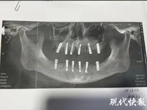 Berkaca Kasus Viral Pria China, Ini Saran Dokter Biar Cabut Gigi Tak Berujung Fatal