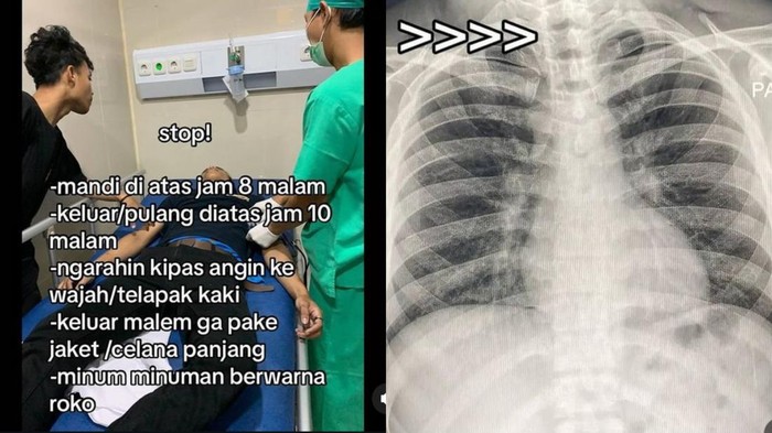 Viral Penampakan Paru-paru Basah Disebut gegara Kipas Angin, Ini Catatan Dokter