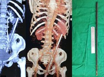 Ngeri! Wanita Ini Tertusuk Batang Logam Berkarat Sepanjang 60 Cm di Rektumnya