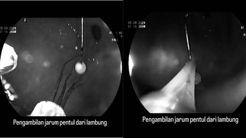 Viral dokter keluarkan jarum pentul dari lambung